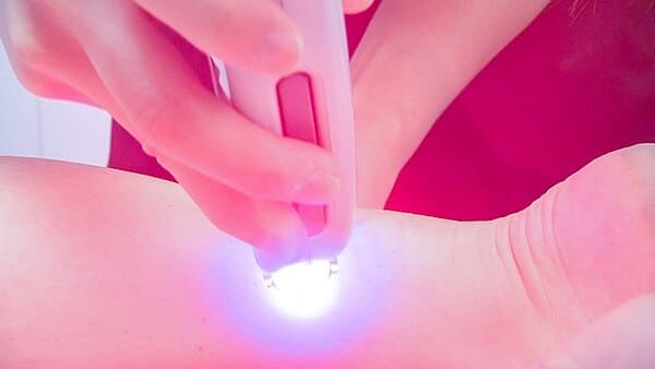 epilation-au-laser